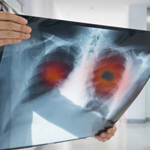 tratamiento de broncoscopia